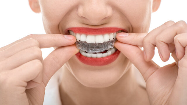Tackling the Stigma of Orthodontic Treatment with Invisalign in Plymouth