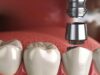 Transform Your Smile: The Impact Of Cosmetic Dentistry On Confidence Cosmetic Dentistry
