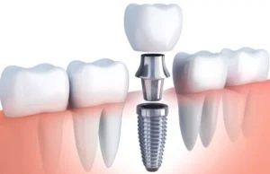 Why Foot And Dental Implants Are Essential For Active Living Dental Implants