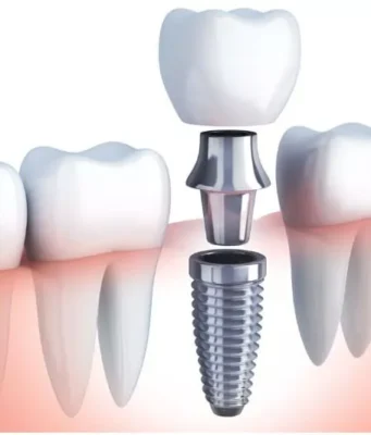 Why Foot And Dental Implants Are Essential For Active Living Dental Implants