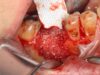Bone Grafting In Implant Dentistry: What Patients Should Know