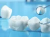 Understanding Fillings, Crowns, and Other Common Dental Restorations Dental Restorations