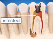 How General Dentists Detect And Treat Cavities Early Treat Cavities