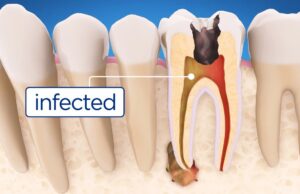 How General Dentists Detect And Treat Cavities Early Treat Cavities