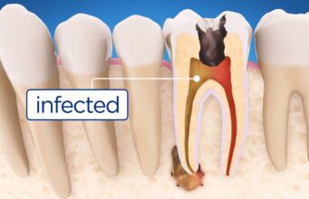 How General Dentists Detect And Treat Cavities Early Treat Cavities