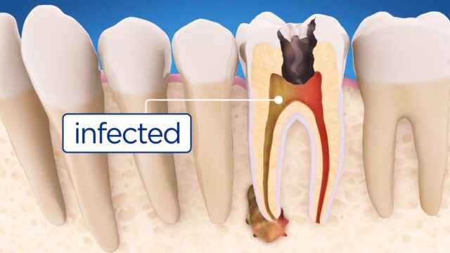 Treat Cavities