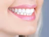 Teeth Whitening After A Dental Cleaning: What You Should Know