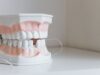 The Role Of Facial Structure In Choosing Between Dentures And Implants Dentures