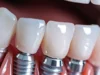 4 Key Differences Between Zygomatic And Conventional Dental Implants Zygomatic vs Conventional Dental Implants