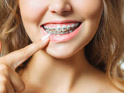 Preparing Your Child For Braces: A Guide From Family Dentistry Experts Braces