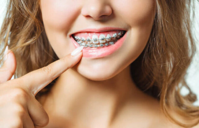 Braces